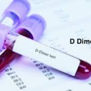 DDM (D-Dimer)